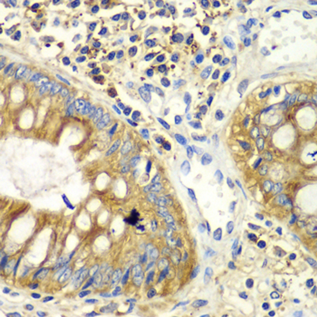 Immunohistochemistry of paraffin-embedded Human colon using PICK1 Polyclonal Antibody at dilution of  1:100 (40x lens).
