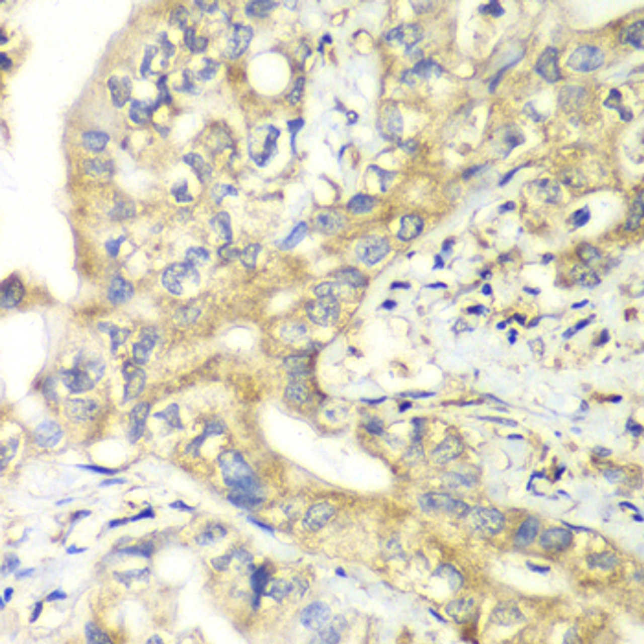 Immunohistochemistry of paraffin-embedded Human liver cancer using TIMM17A Polyclonal Antibody at dilution of  1:100 (40x lens).