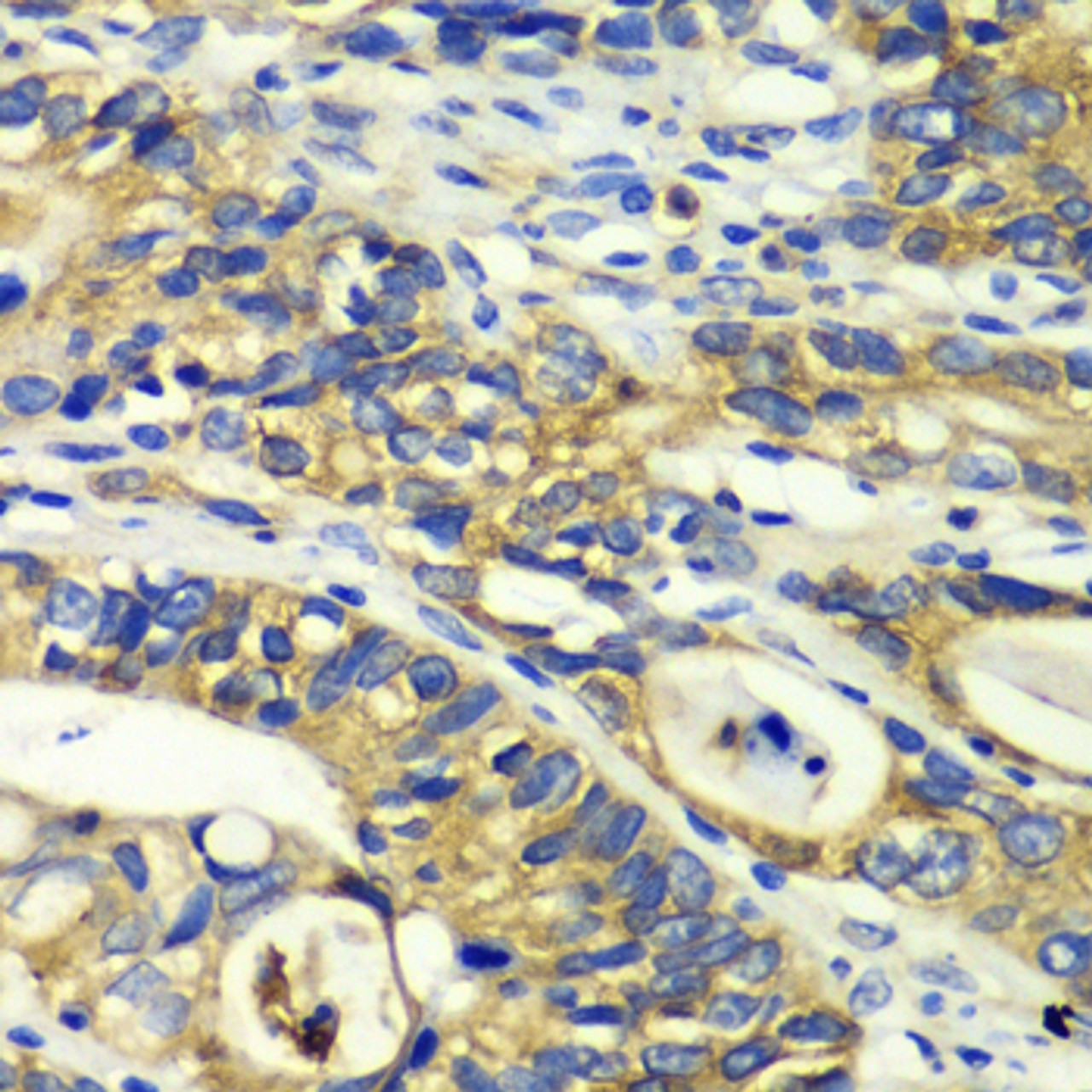 Immunohistochemistry of paraffin-embedded Human colon carcinoma using RPH3A Polyclonal Antibody at dilution of  1:100 (40x lens).