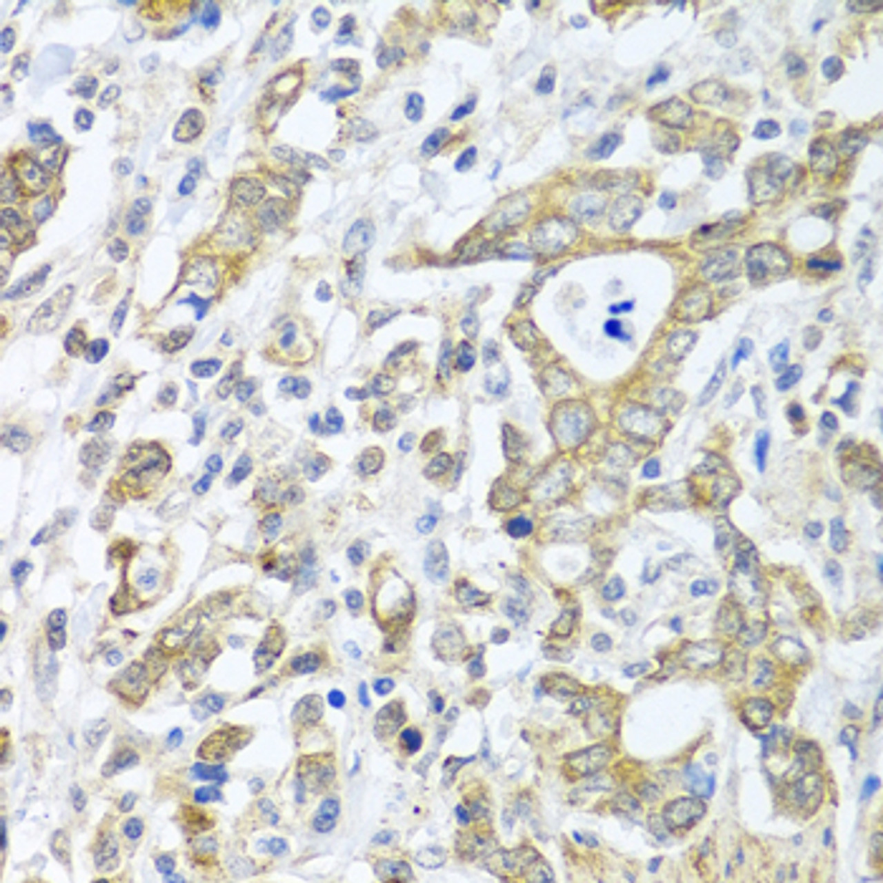 Immunohistochemistry of paraffin-embedded Human gastric cancer using TICAM1 Polyclonal Antibody at dilution of  1:100 (40x lens).