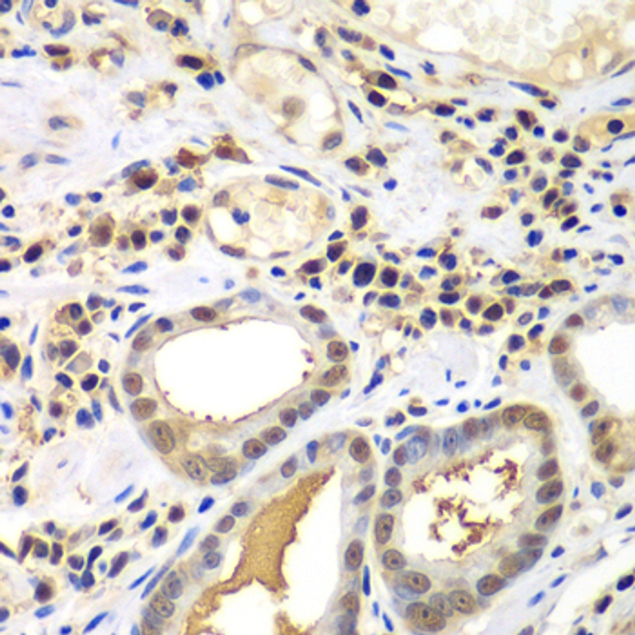 Immunohistochemistry of paraffin-embedded Human gastric cancer using PSME2 Polyclonal Antibody at dilution of  1:100 (40x lens).