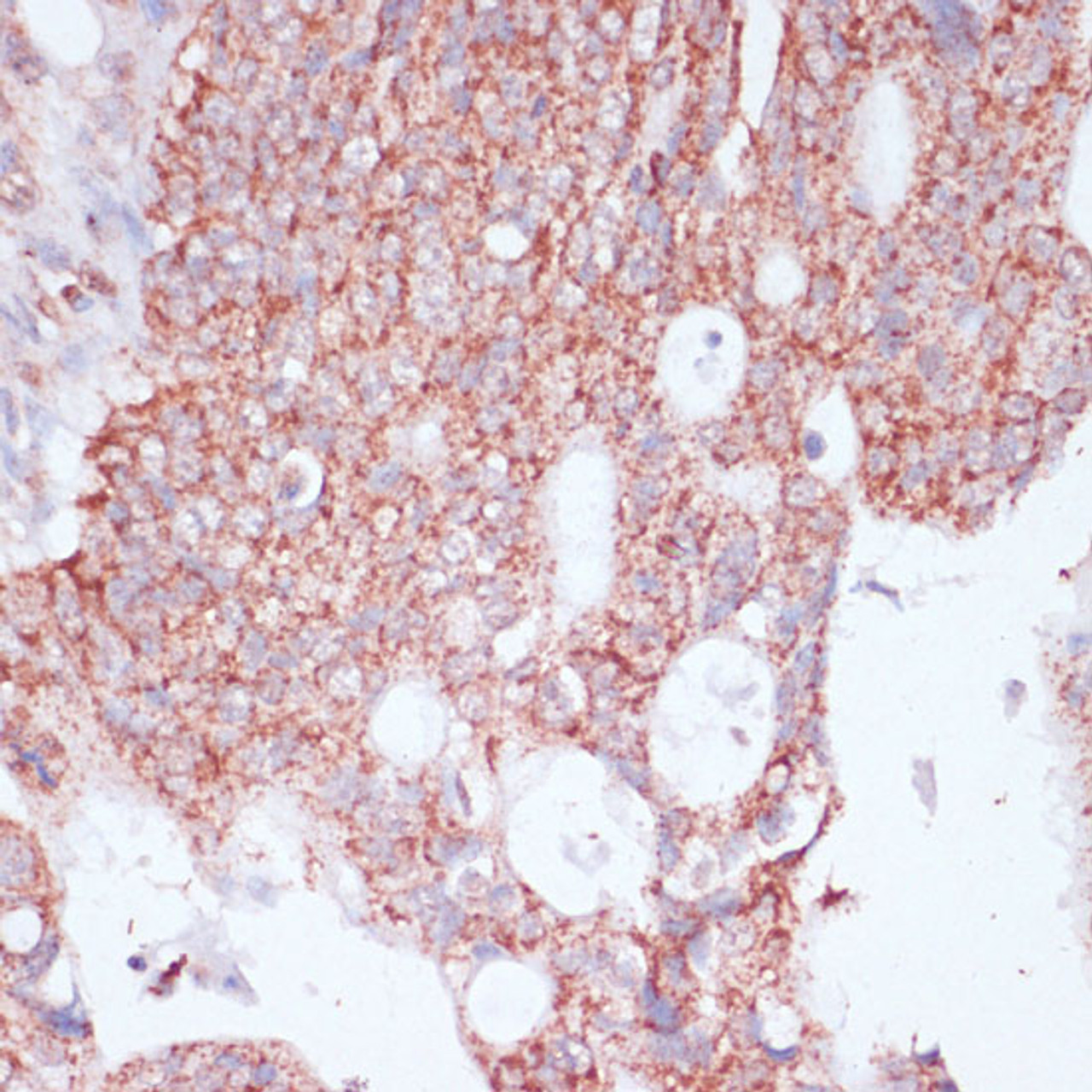 Immunohistochemistry of paraffin-embedded Human colon carcinoma using RPL30 Polyclonal Antibody at dilution of  1:100 (40x lens).