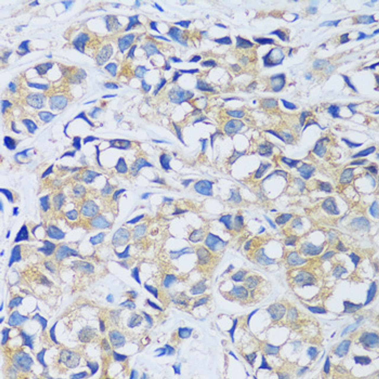 Immunohistochemistry of paraffin-embedded Human breast cancer using CABP7 Polyclonal Antibody at dilution of  1:100 (40x lens).