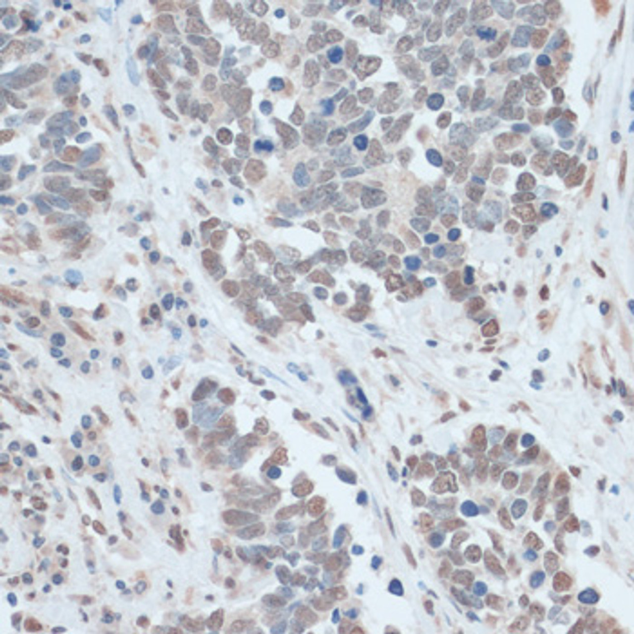 Immunohistochemistry of paraffin-embedded Human lung cancer using ZNF707 Polyclonal Antibody at dilution of  1:100 (40x lens).