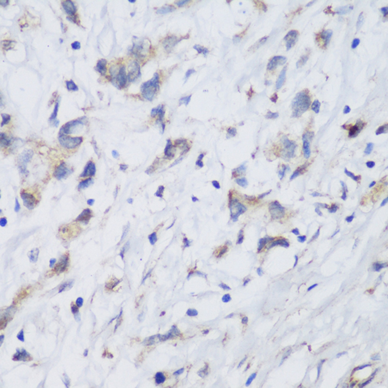 Immunohistochemistry of paraffin-embedded Human gastric cancer using FA2H Polyclonal Antibody at dilution of  1:150 (40x lens).