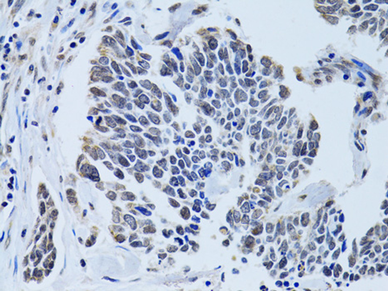 Immunohistochemistry of paraffin-embedded Human lung cancer using SIN3A Polyclonal Antibody at dilution of  1:100 (40x lens).