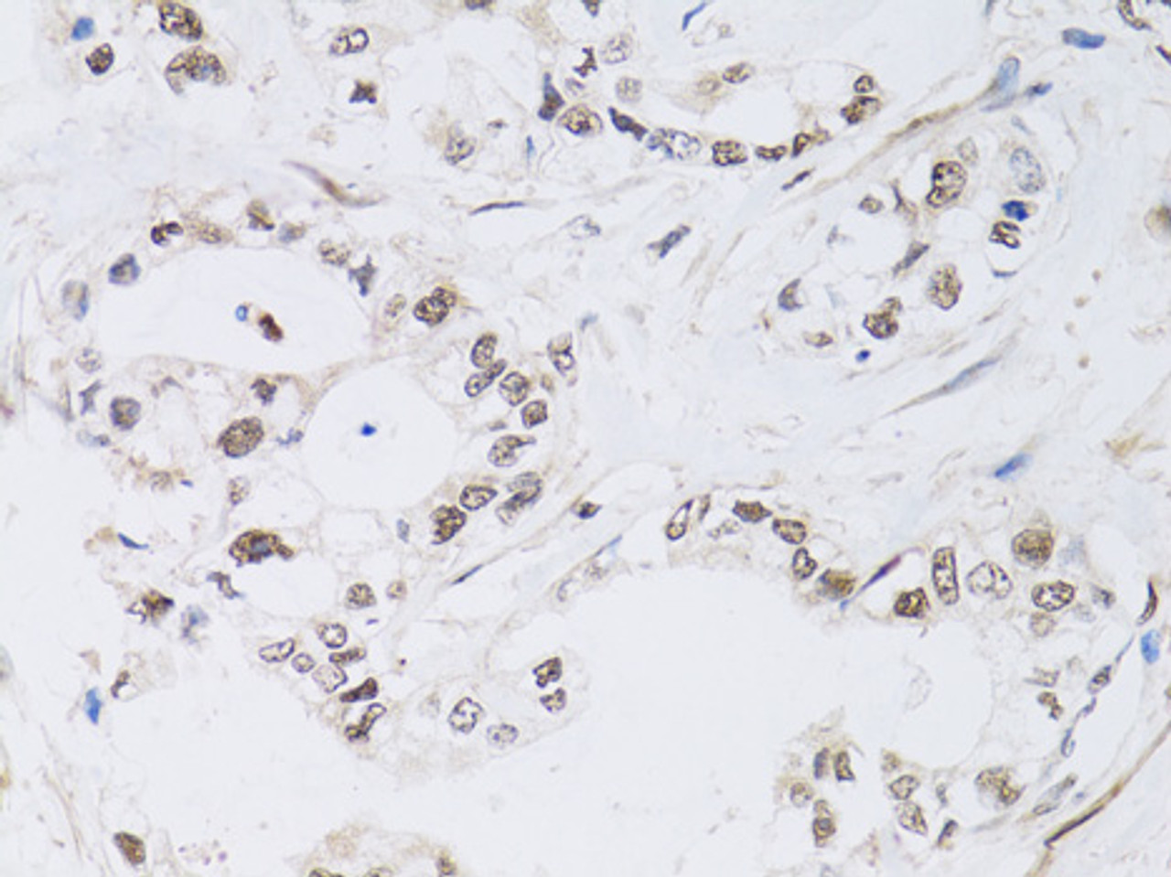 Immunohistochemistry of paraffin-embedded Human gastric cancer using PAX3 Polyclonal Antibody at dilution of  1:100 (40x lens).