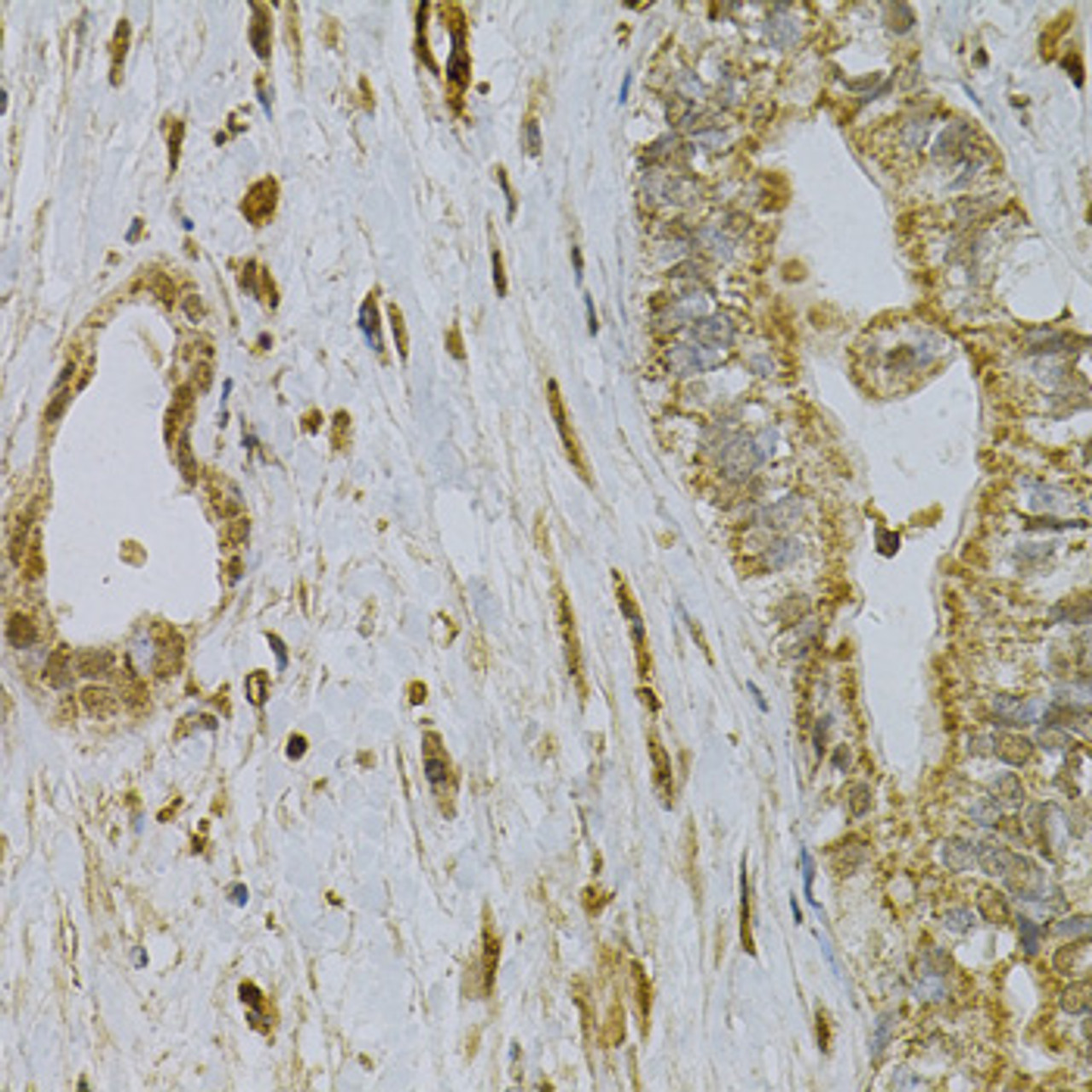 Immunohistochemistry of paraffin-embedded Human liver cancer using CDA Polyclonal Antibody at dilution of  1:100 (40x lens).