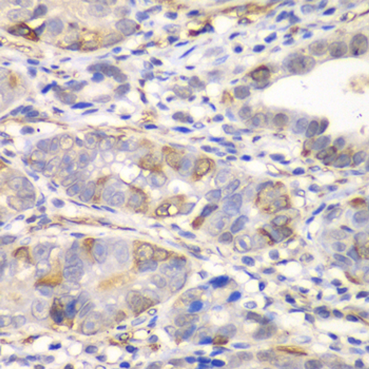 Immunohistochemistry of paraffin-embedded Human gastric cancer using GCLM Polyclonal Antibody at dilution of  1:100 (40x lens).