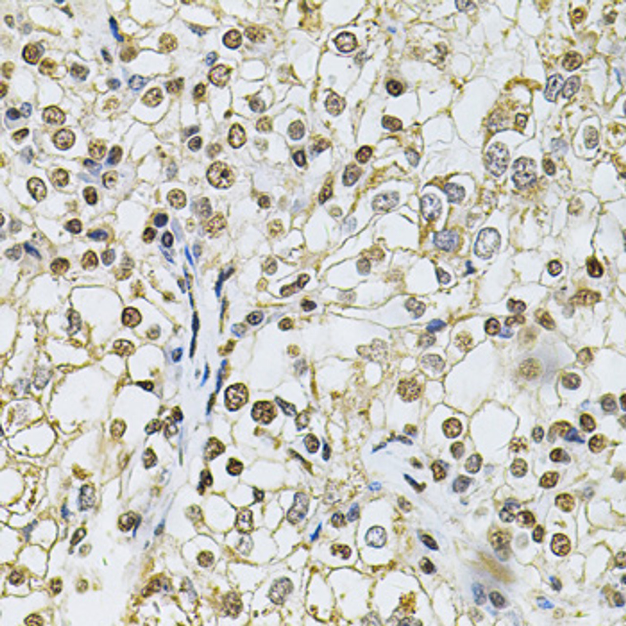 Immunohistochemistry of paraffin-embedded Human kidney cancer using IFI16 Polyclonal Antibody at dilution of  1:100 (40x lens).