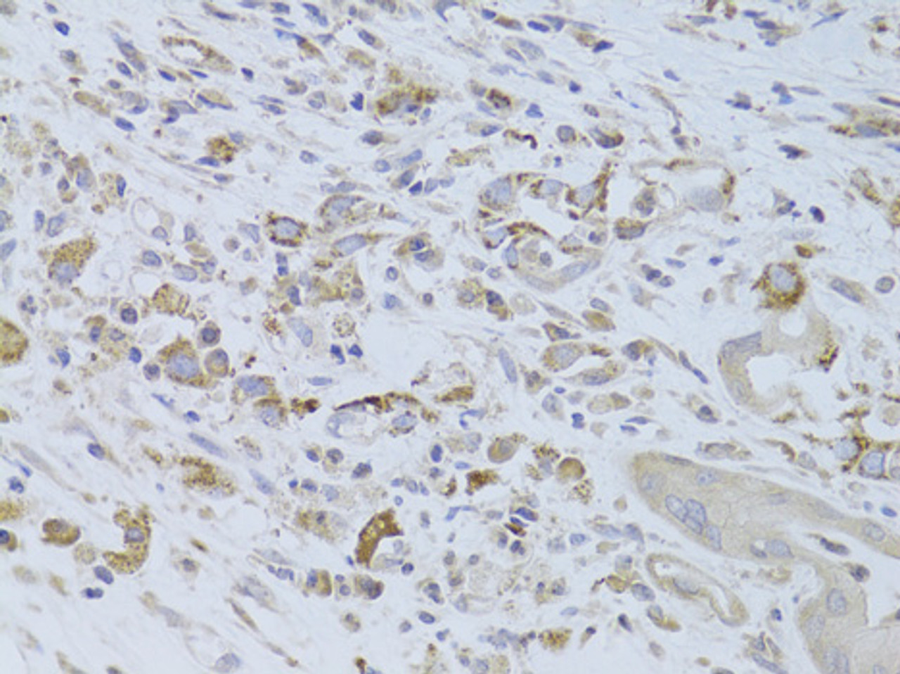 Immunohistochemistry of paraffin-embedded Human breast cancer using IGF2 Polyclonal Antibody at dilution of  1:100 (40x lens).