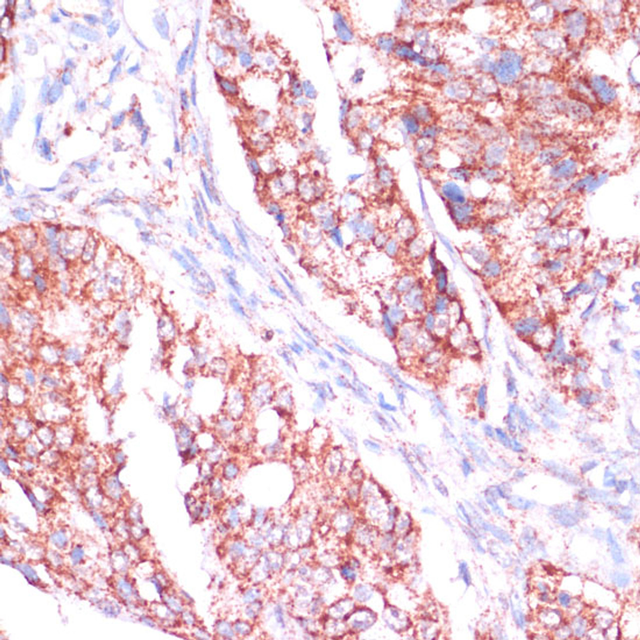 Immunohistochemistry of paraffin-embedded Human colon carcinoma using RPL24 Polyclonal Antibody at dilution of  1:100 (40x lens).