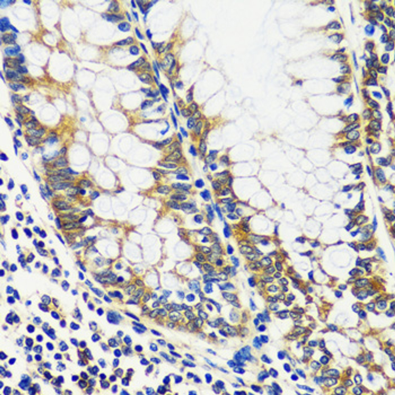 Immunohistochemistry of paraffin-embedded Human colon using CCDC124 Polyclonal Antibody at dilution of  1:100 (40x lens).