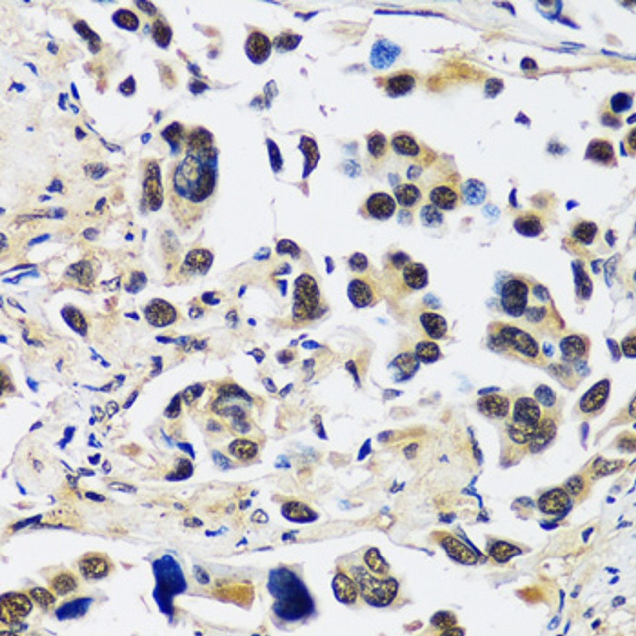 Immunohistochemistry of paraffin-embedded Human lung cancer using CCDC59 Polyclonal Antibody at dilution of  1:100 (40x lens).