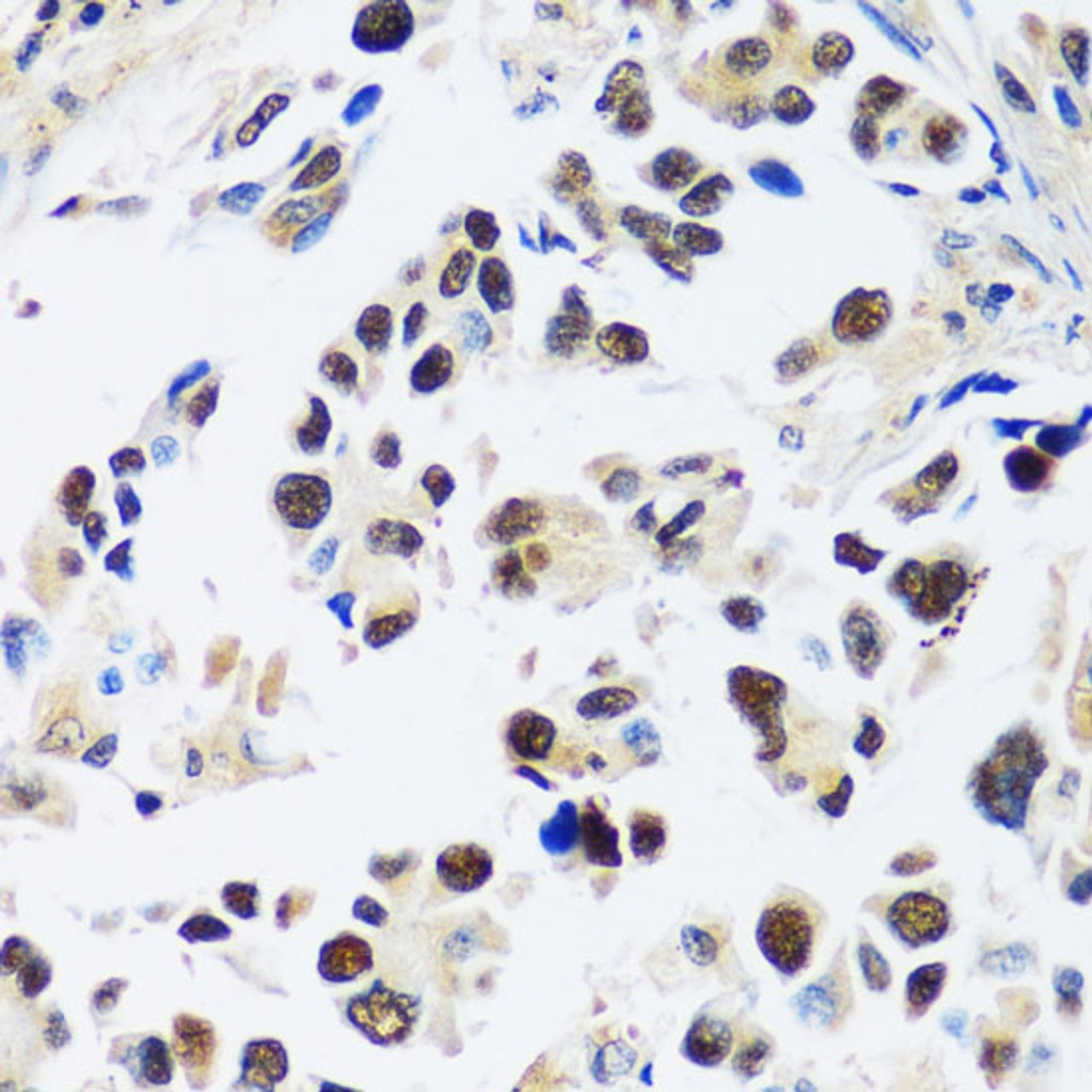 Immunohistochemistry of paraffin-embedded Human lung cancer using ASCL4 Polyclonal Antibody at dilution of  1:100 (40x lens).