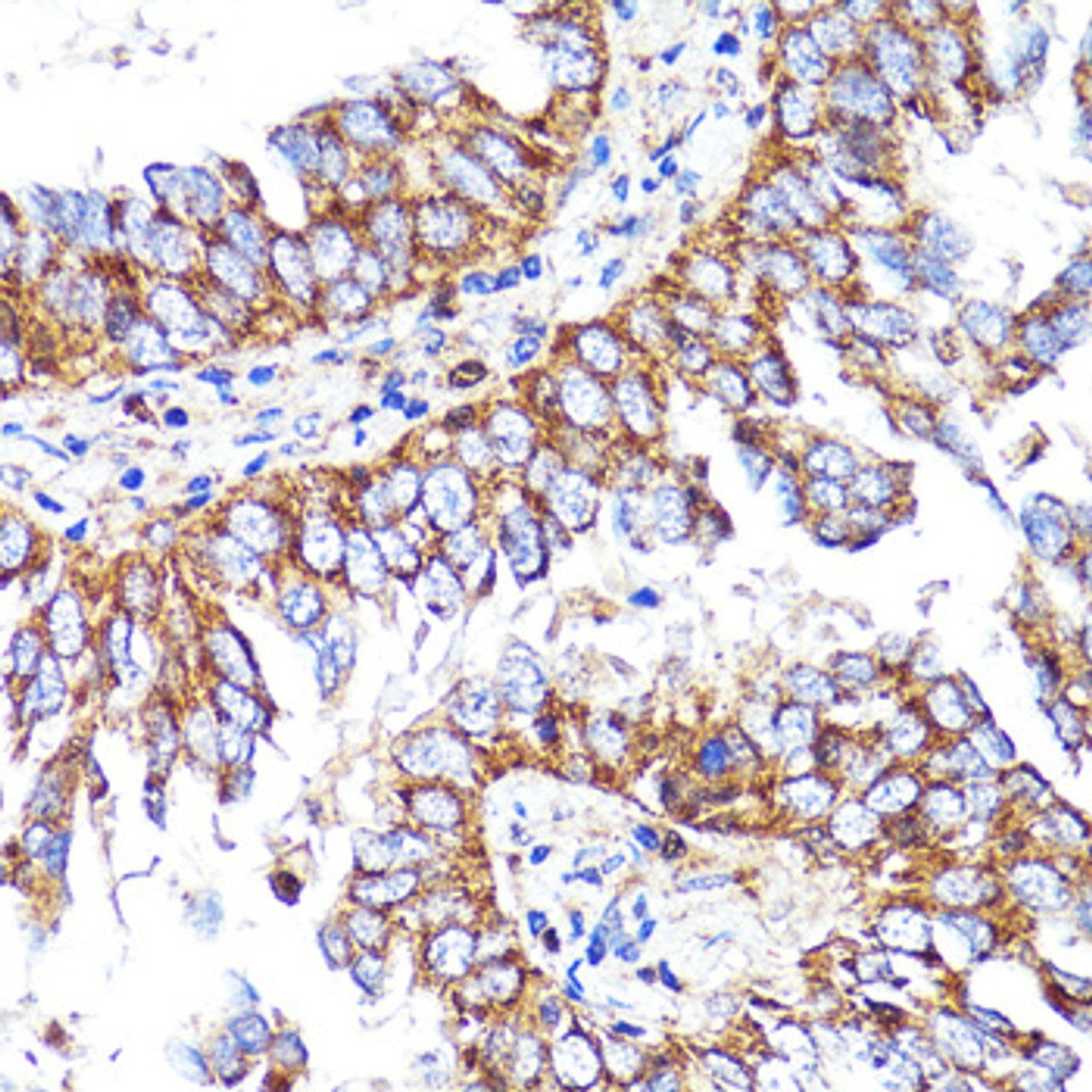 Immunohistochemistry of paraffin-embedded Human lung cancer using CNR1 Polyclonal Antibody at dilution of  1:150 (40x lens).