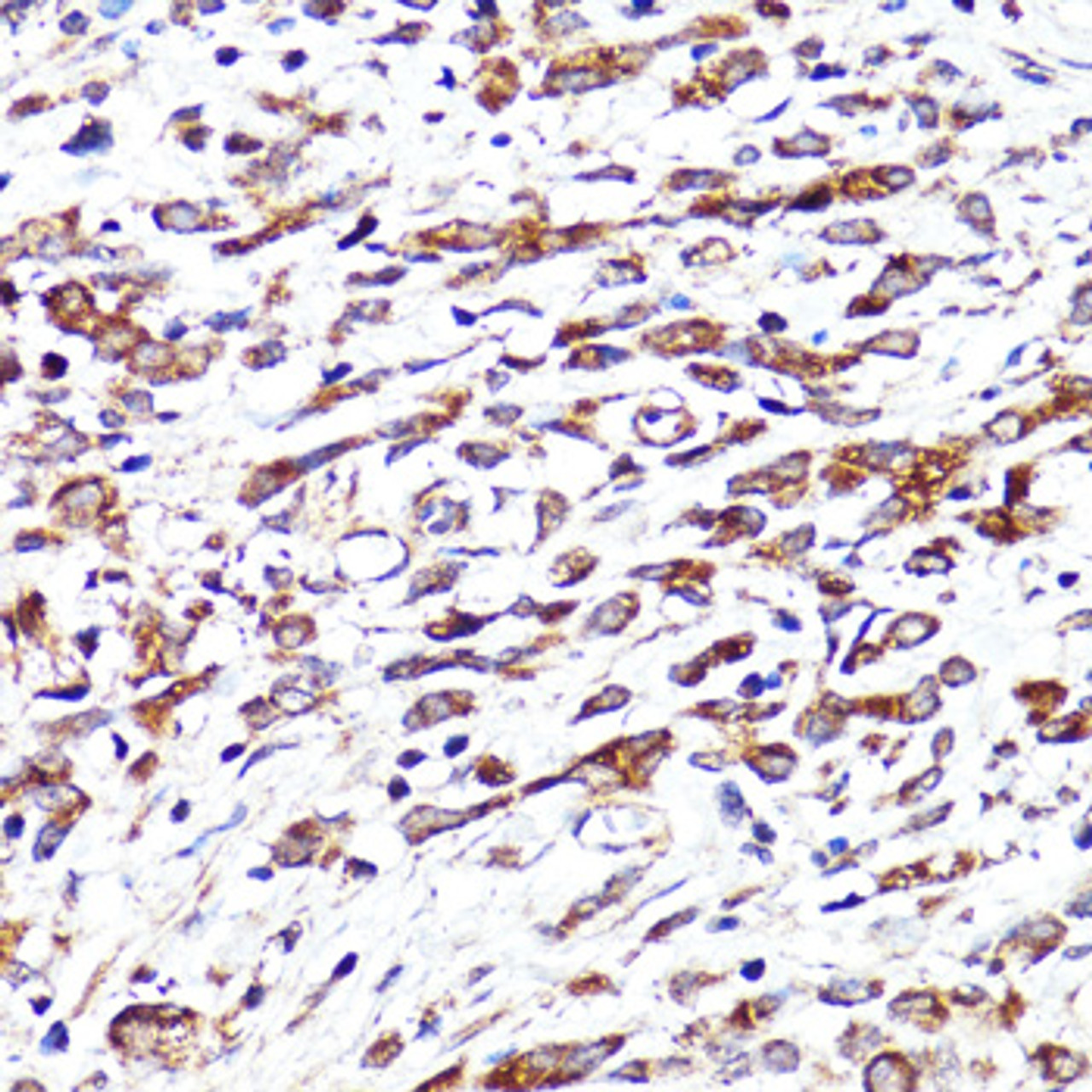 Immunohistochemistry of paraffin-embedded Human stomach cancer using CNR1 Polyclonal Antibody at dilution of  1:150 (40x lens).