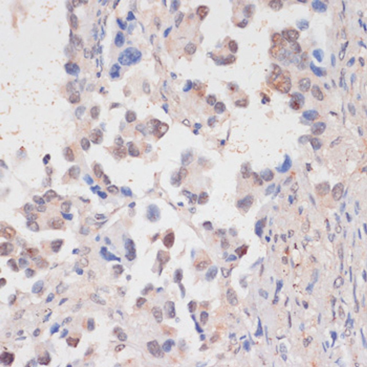 Immunohistochemistry of paraffin-embedded Human lung cancer using HTATSF1 Polyclonal Antibody at dilution of  1:100 (40x lens).