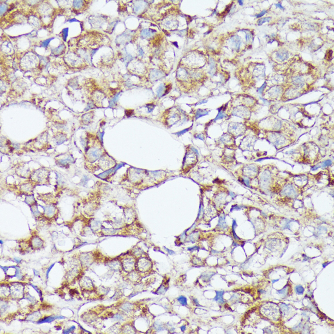 Immunohistochemistry of paraffin-embedded Human mammary cancer using SLC7A2 Polyclonal Antibody at dilution of  1:100 (40x lens).