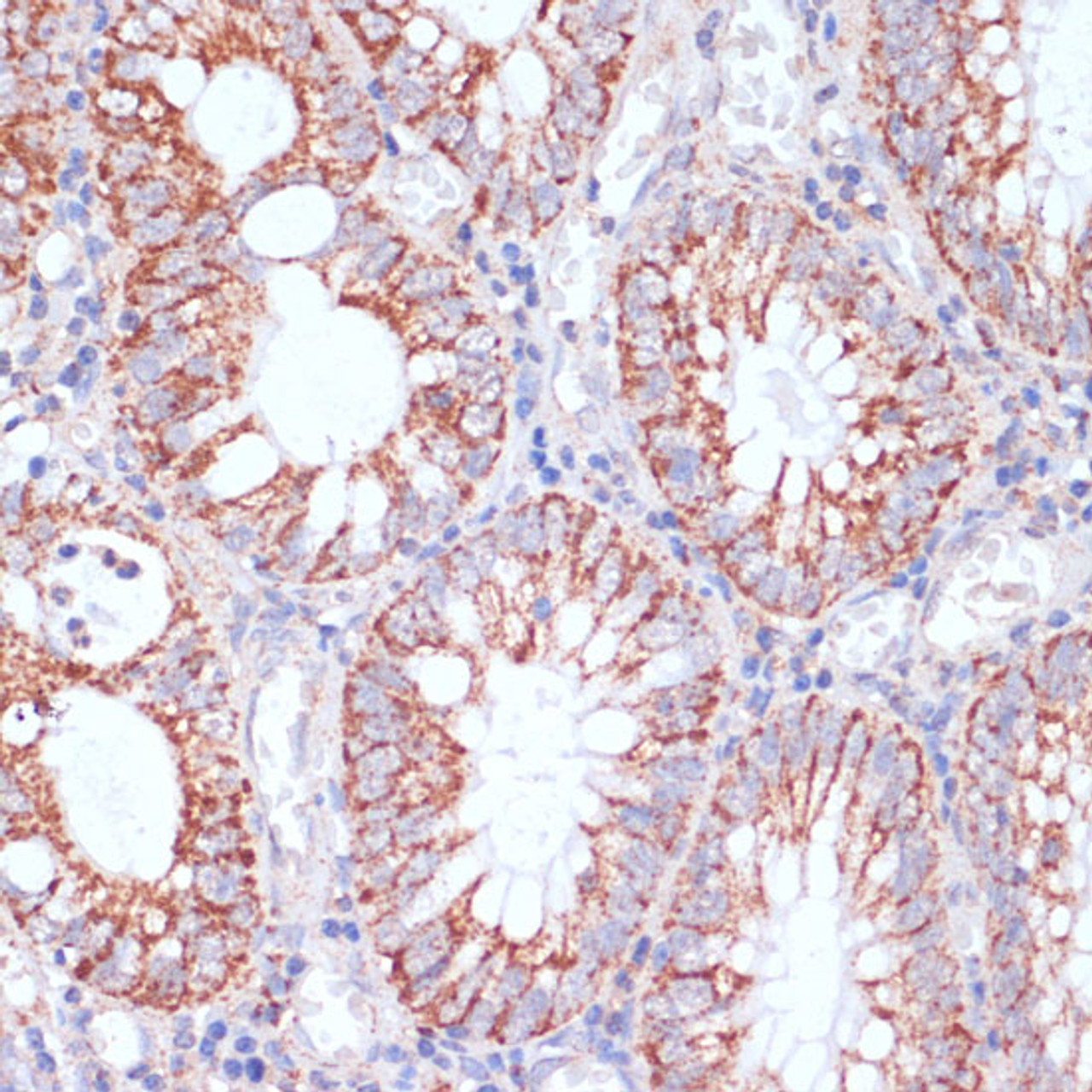 Immunohistochemistry of paraffin-embedded Human colon carcinoma using HIGD1A Polyclonal Antibody at dilution of  1:100 (40x lens).