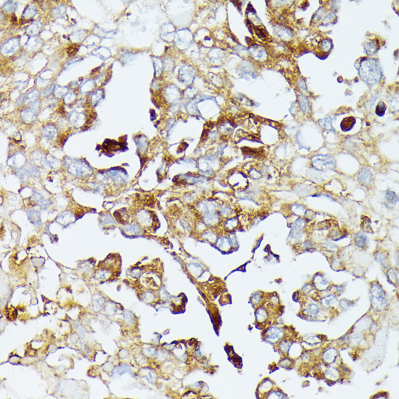Immunohistochemistry of paraffin-embedded Human lung cancer using COX15 Polyclonal Antibody at dilution of  1:100 (40x lens).