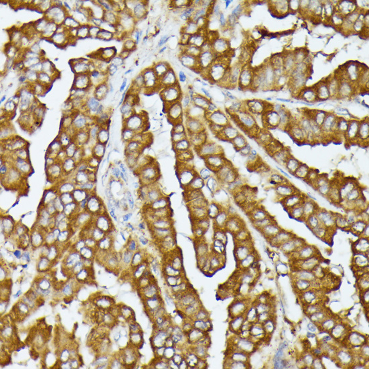 Immunohistochemistry of paraffin-embedded Human thyroid cancer using COX15 Polyclonal Antibody at dilution of  1:100 (40x lens).