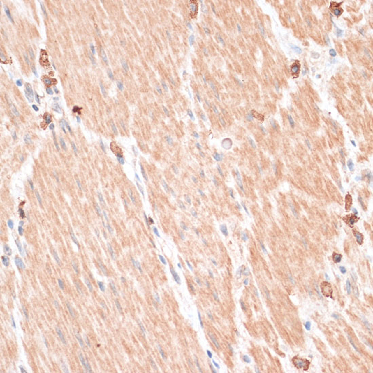 Immunohistochemistry of paraffin-embedded Human gastric cancer using ABCB7 Polyclonal Antibody at dilution of  1:100 (40x lens).