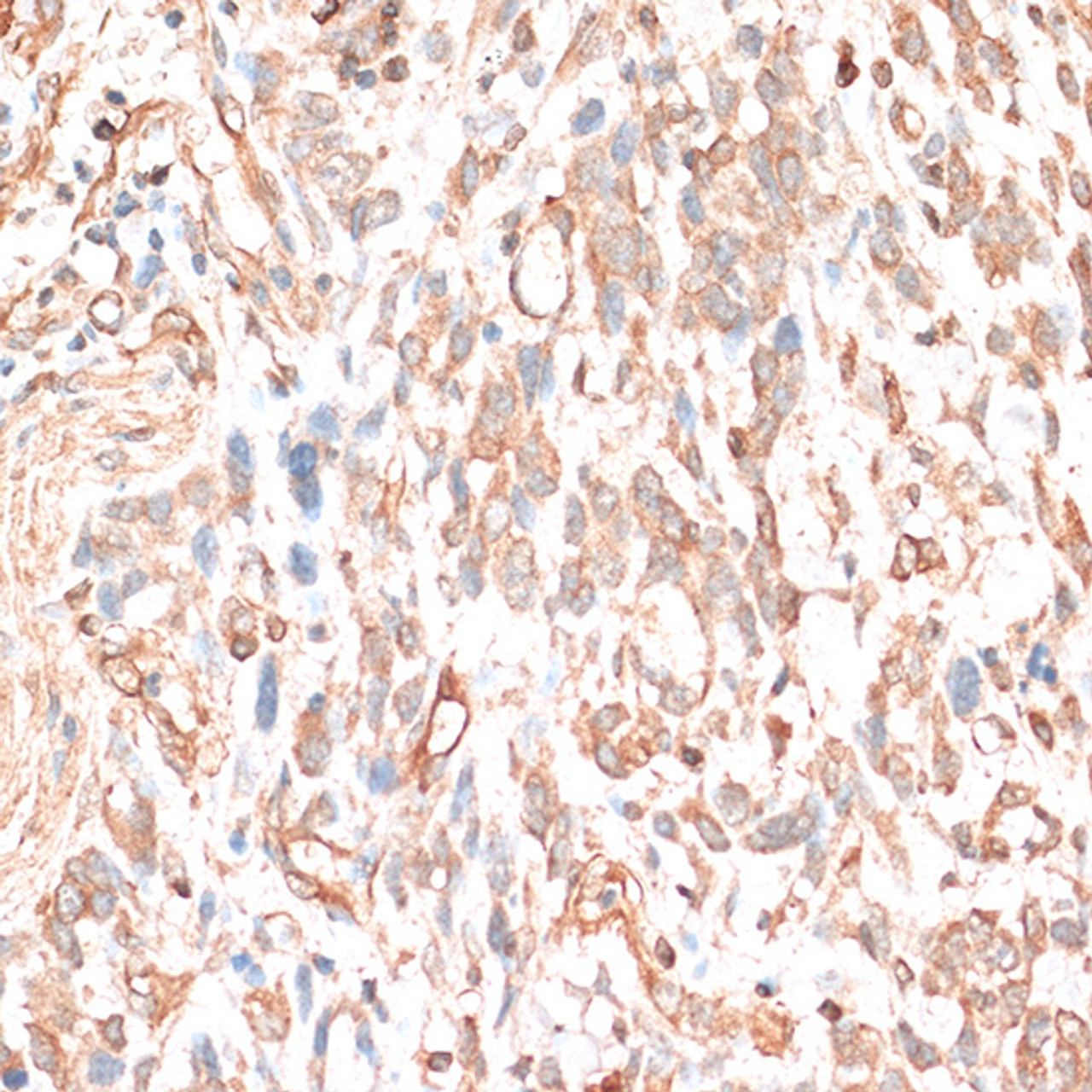 Immunohistochemistry of paraffin-embedded Human gastric cancer using CDH11 Polyclonal Antibody at dilution of  1:100 (40x lens).