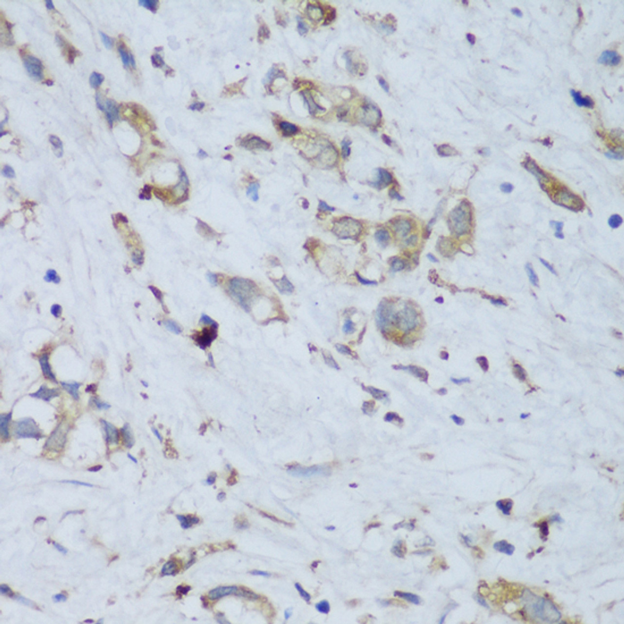 Immunohistochemistry of paraffin-embedded Human gastric cancer using ENPP3 Polyclonal Antibody at dilution of  1:150 (40x lens).