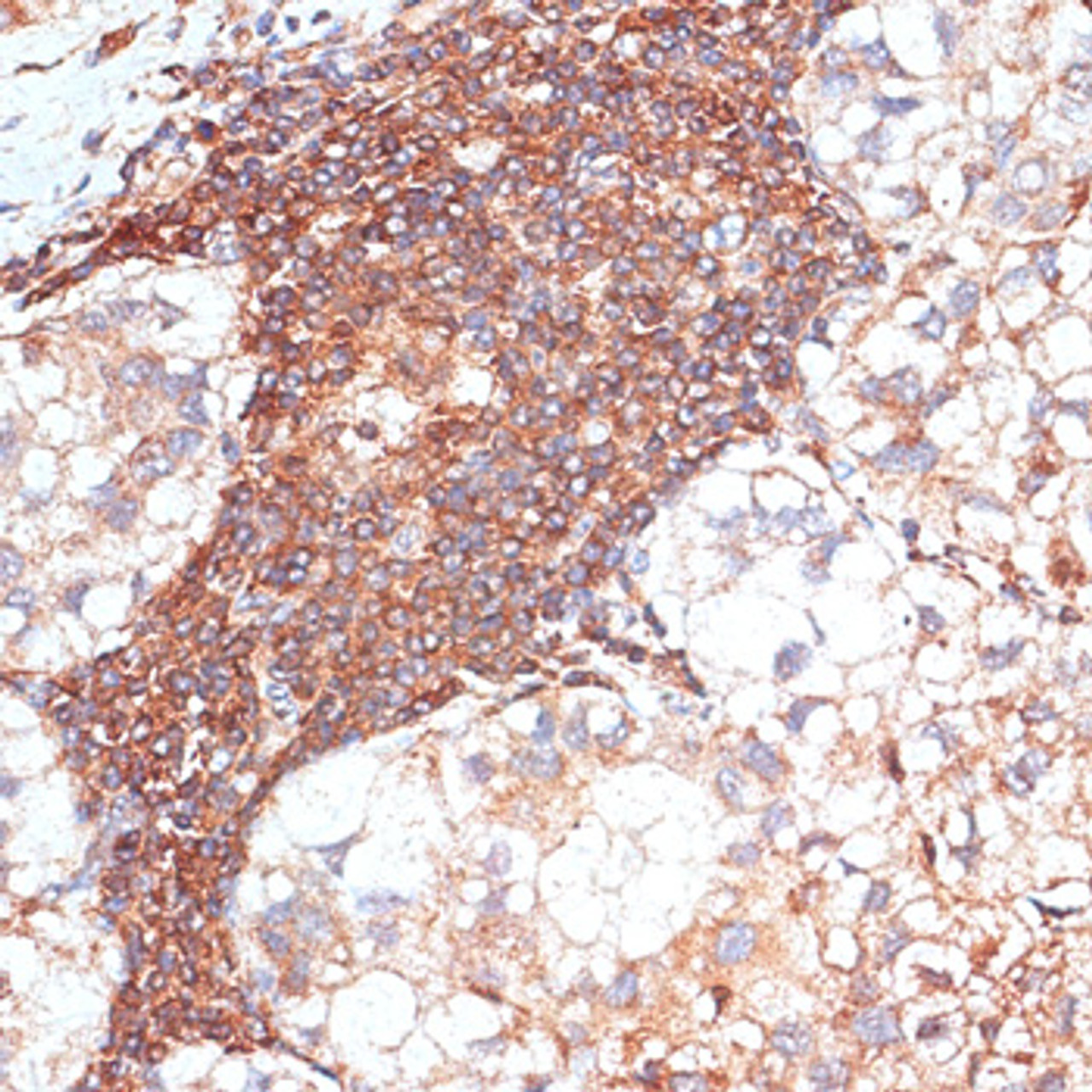 Immunohistochemistry of paraffin-embedded Human liver cancer using G3BP1 Polyclonal Antibody at dilution of  1:100 (40x lens).