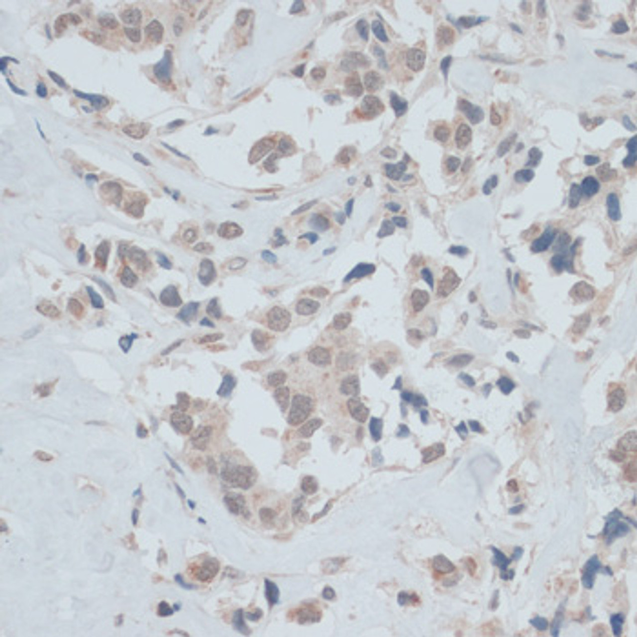 Immunohistochemistry of paraffin-embedded Human breast cancer using ZNF446 Polyclonal Antibody at dilution of  1:100 (40x lens).