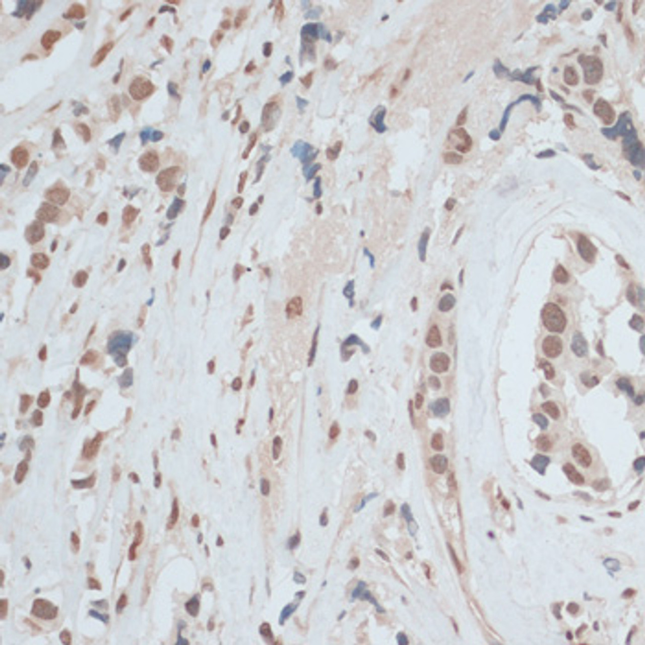 Immunohistochemistry of paraffin-embedded Human breast cancer using ZNF574 Polyclonal Antibody at dilution of  1:100 (40x lens).