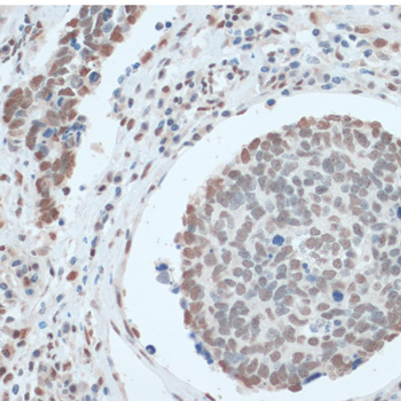 Immunohistochemistry of paraffin-embedded Human lung cancer using ZNF433 Polyclonal Antibody at dilution of  1:100 (40x lens).