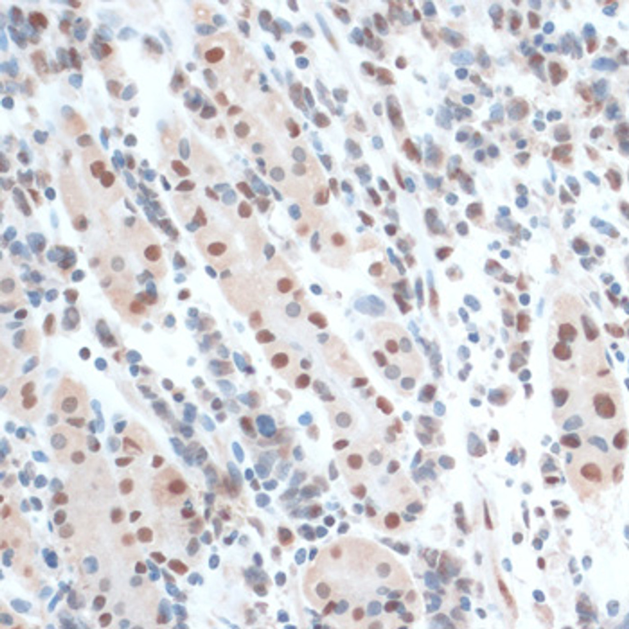 Immunohistochemistry of paraffin-embedded Human gastric cancer using ZNF433 Polyclonal Antibody at dilution of  1:100 (40x lens).
