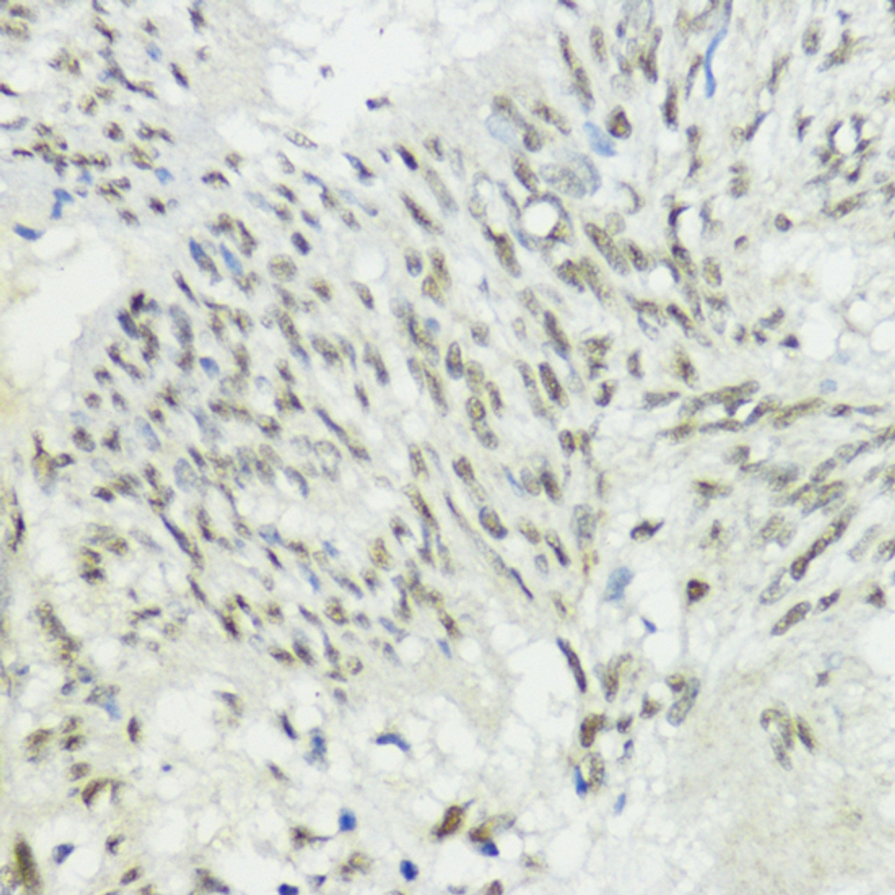 Immunohistochemistry of paraffin-embedded Human gastric cancer using ZEB1 Polyclonal Antibody at dilution of  1:200 (40x lens).