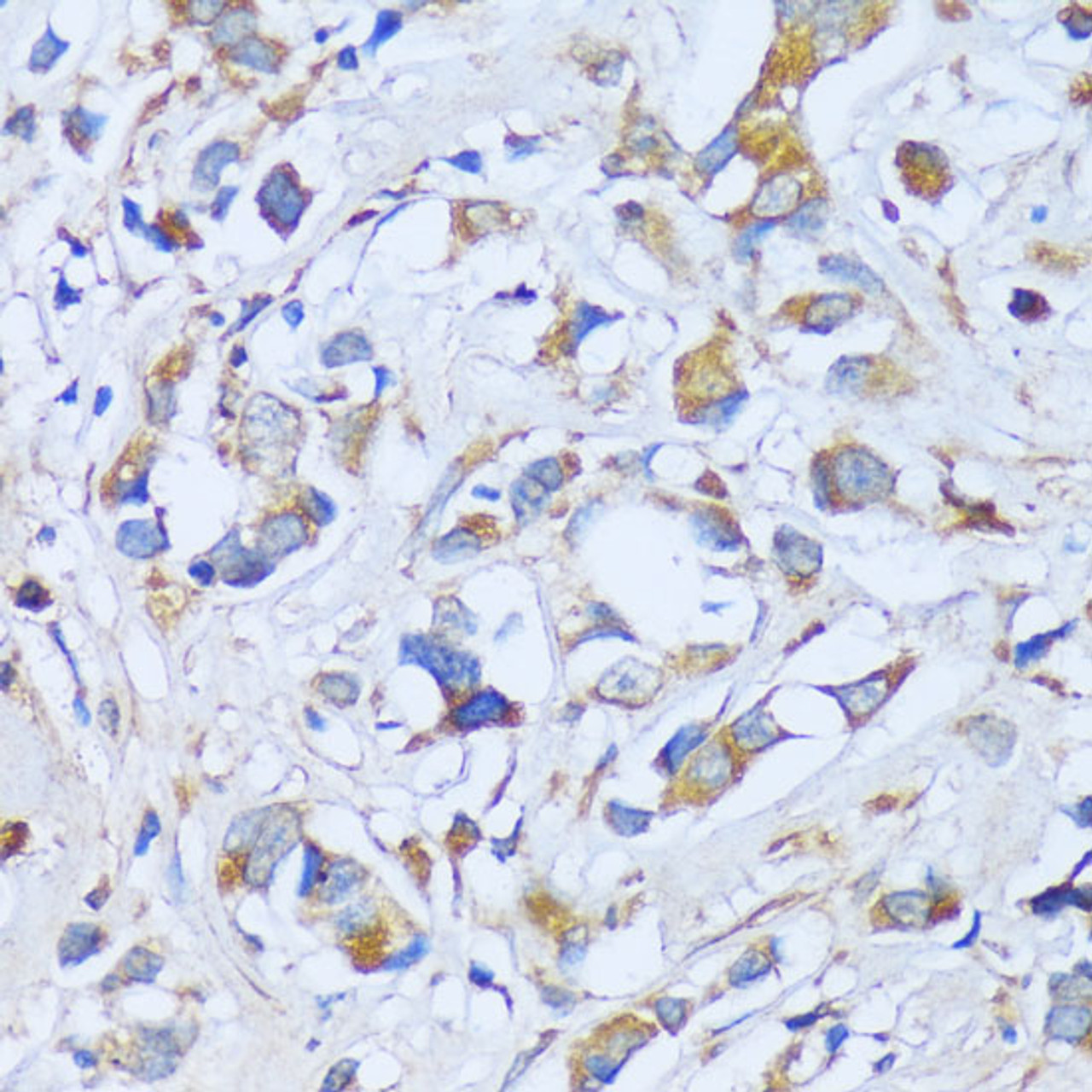 Immunohistochemistry of paraffin-embedded Human breast cancer using ACADSB Polyclonal Antibody at dilution of  1:100 (40x lens).