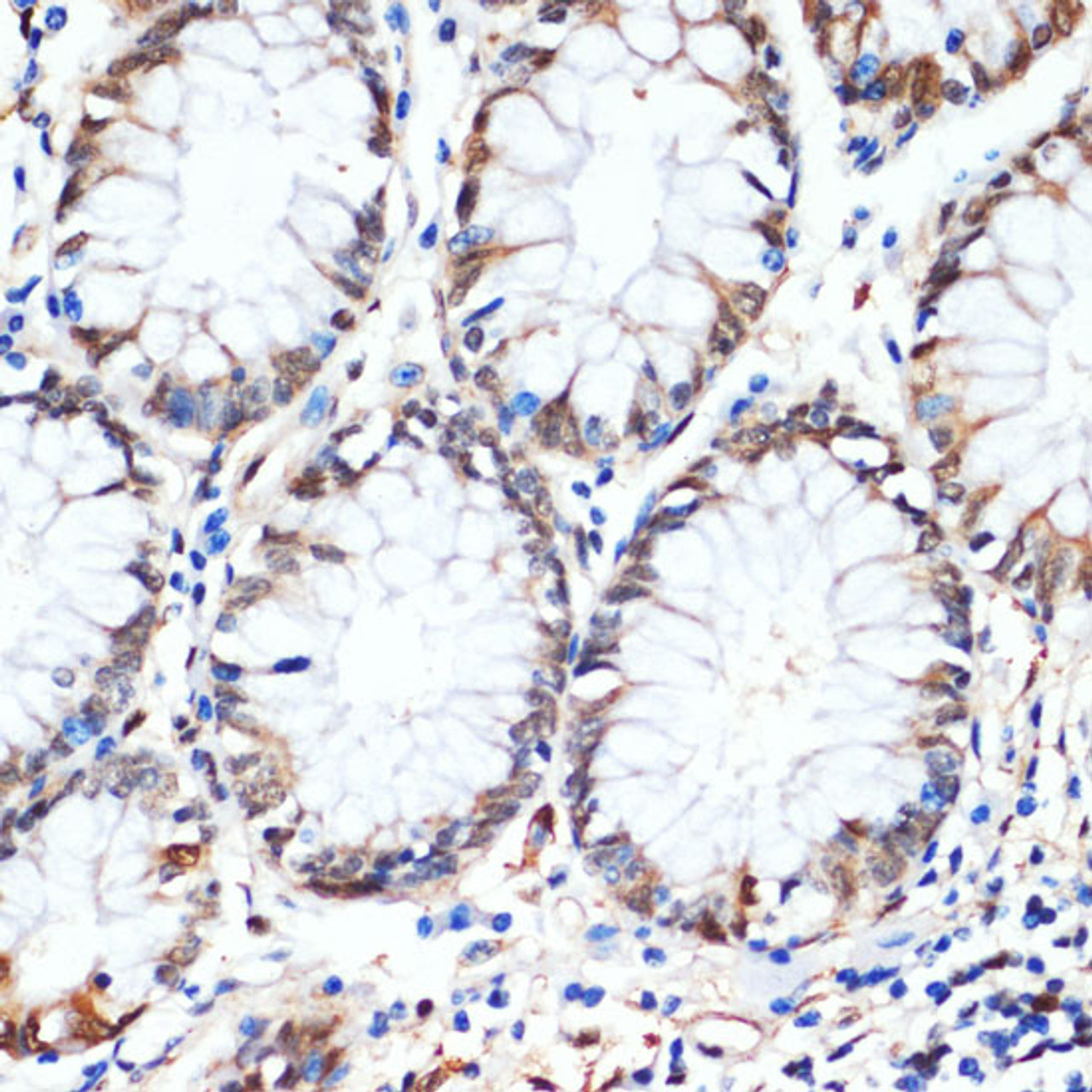 Immunohistochemistry of paraffin-embedded Human colon using HSPA1A Monoclonal Antibody at dilution of  1:100 (40x lens).