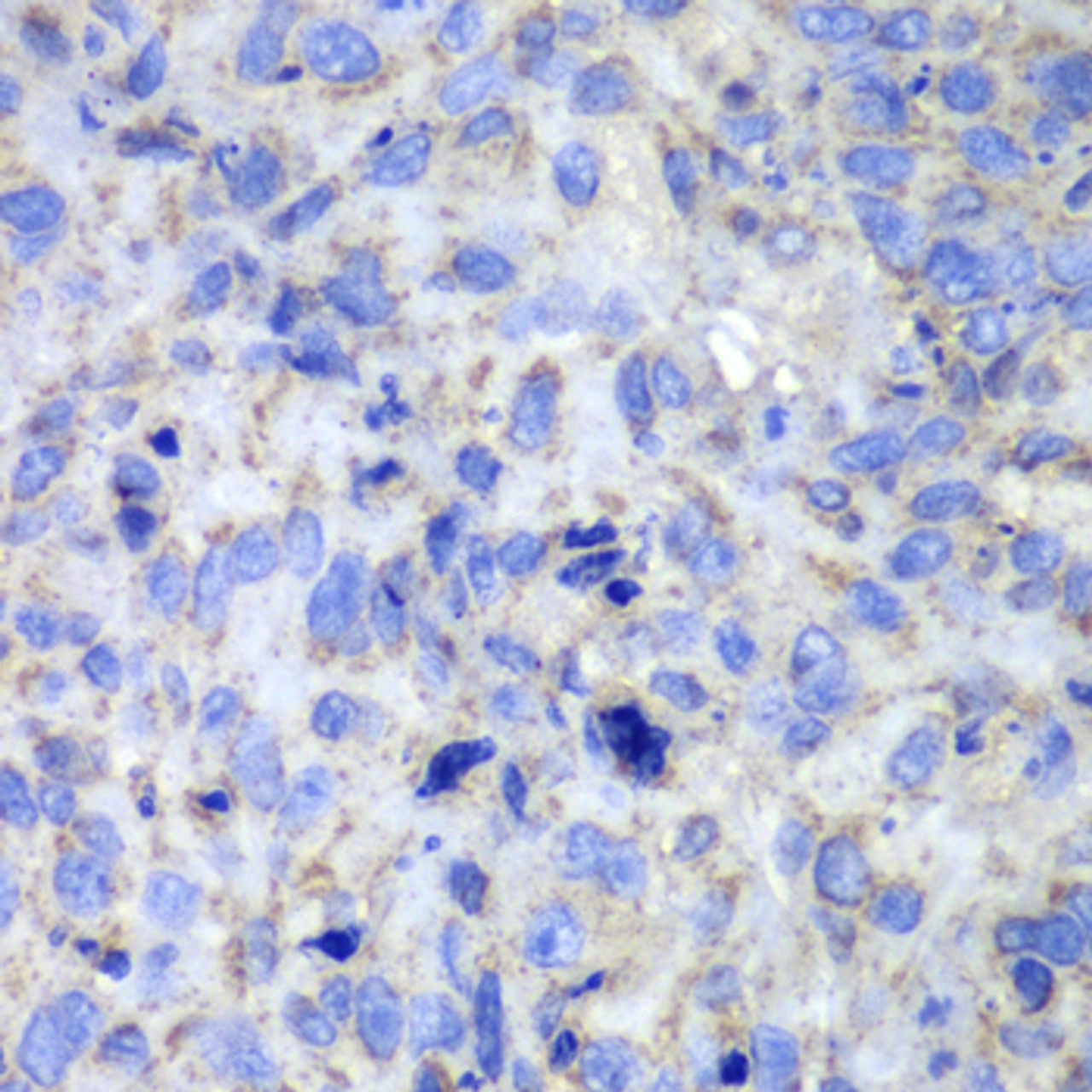 Immunohistochemistry of paraffin-embedded Human lung cancer using Caspase-7 Polyclonal Antibody at dilution of  1:100 (40x lens).