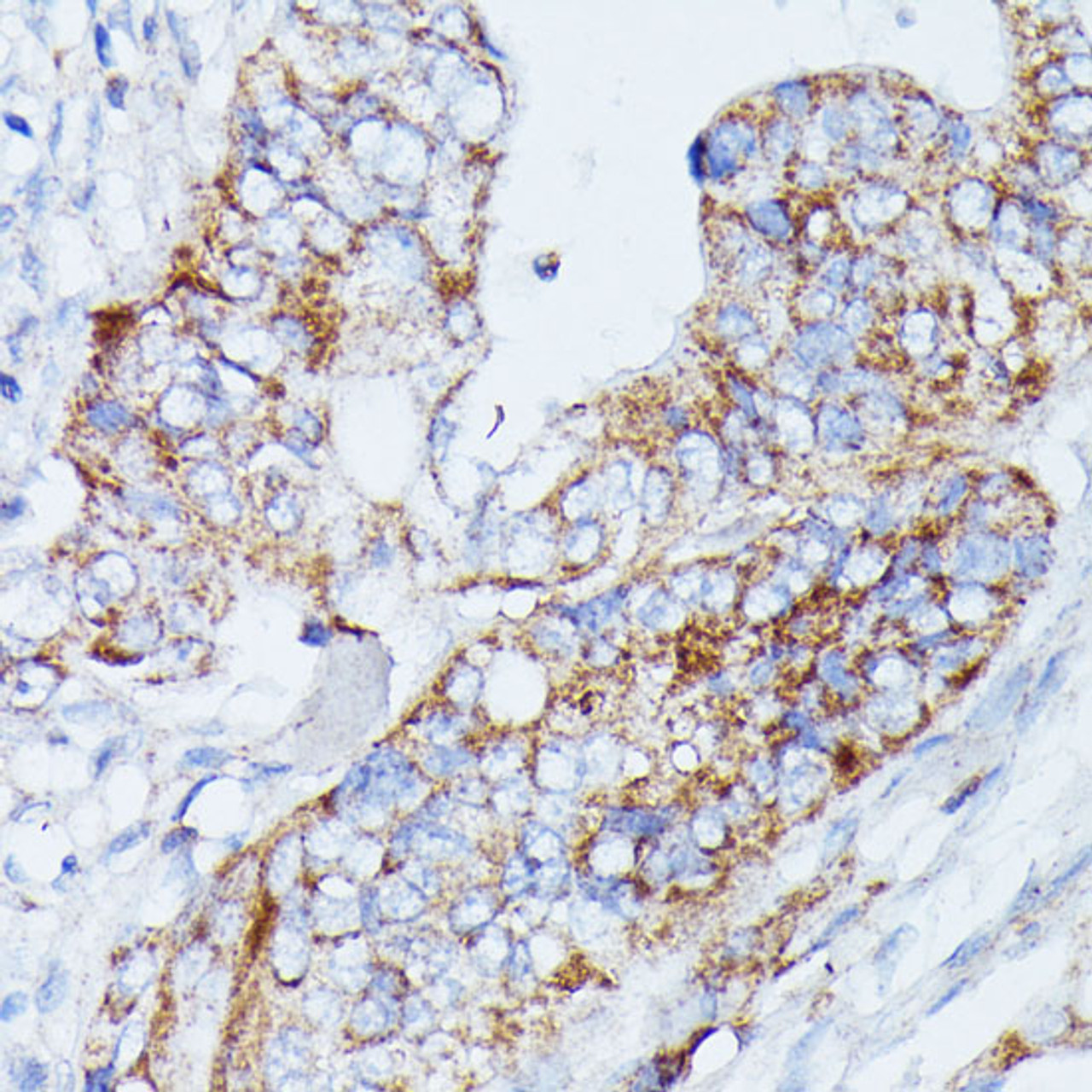 Immunohistochemistry of paraffin-embedded Human colon carcinoma using MANBA Polyclonal Antibody at dilution of  1:100 (40x lens).