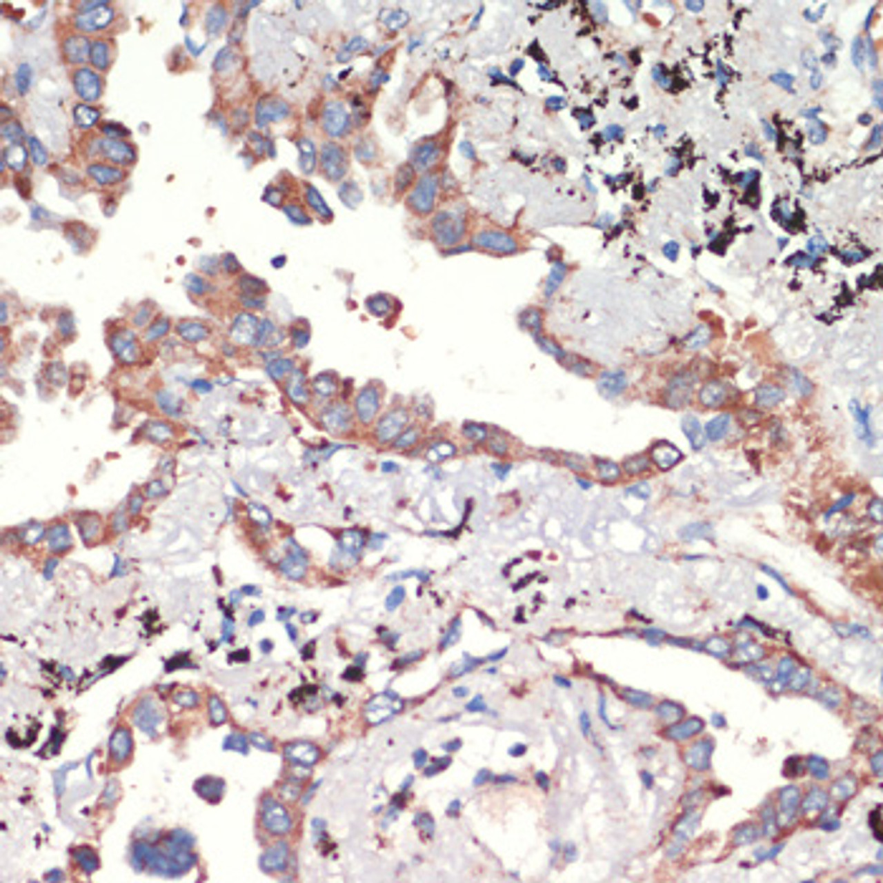 Immunohistochemistry of paraffin-embedded Human lung cancer using AFG3L2 Polyclonal Antibody at dilution of  1:200 (40x lens).