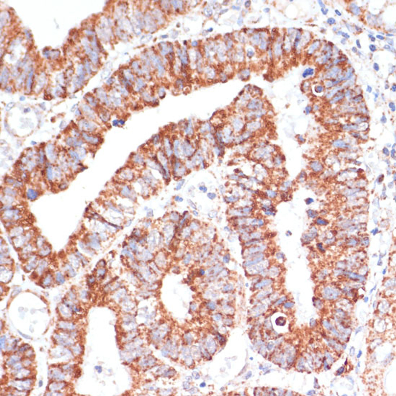Immunohistochemistry of paraffin-embedded Human colon carcinoma using MRPL46 Polyclonal Antibody at dilution of  1:100 (40x lens).