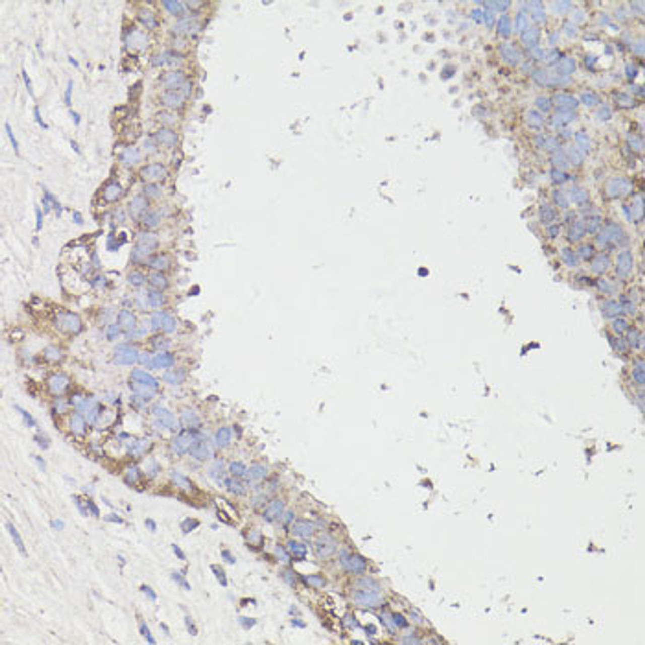 Immunohistochemistry of paraffin-embedded Human mammary cancer using LC3A / LC3B Polyclonal Antibody at dilution of  1:100 (40x lens).