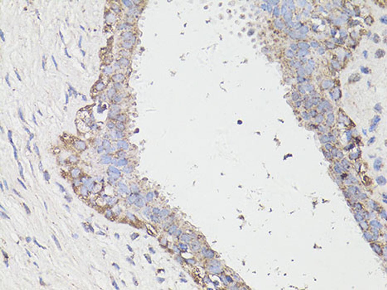 Immunohistochemistry of paraffin-embedded Human breast cancer using LC3A / LC3B Polyclonal Antibody at dilution of  1:100 (40x lens).