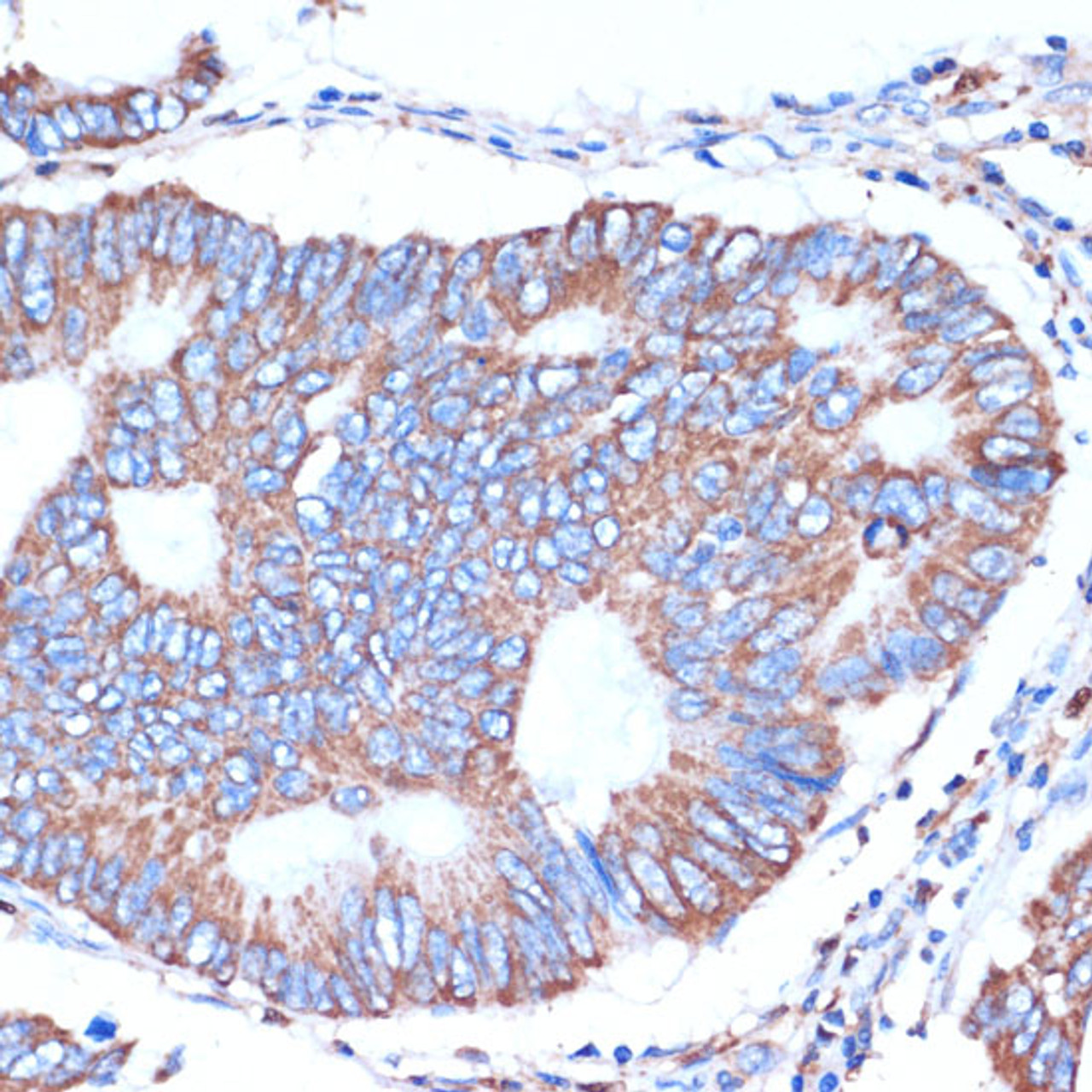 Immunohistochemistry of paraffin-embedded Human colon carcinoma using ITCH Polyclonal Antibody at dilution of  1:50 (40x lens).