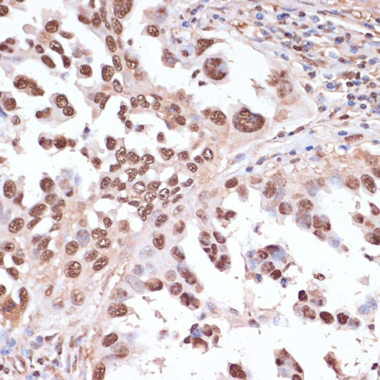 Immunohistochemistry of paraffin-embedded Human lung cancer using ITCH Polyclonal Antibody at dilution of  1:100 (40x lens).