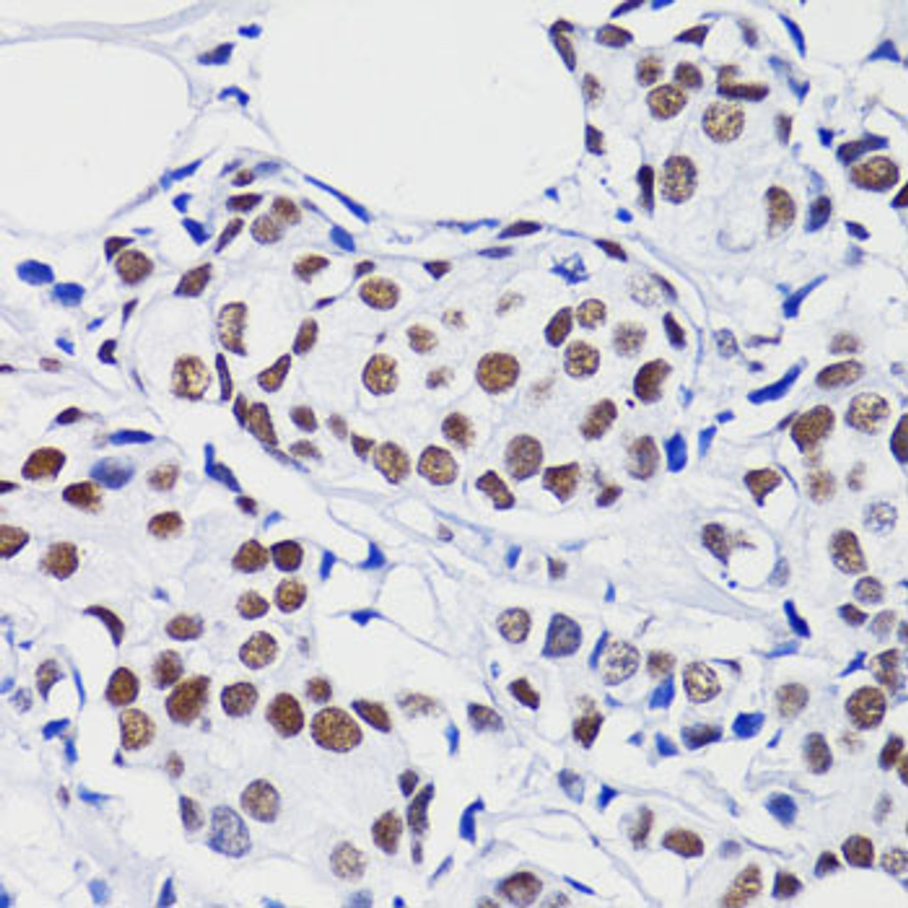 Immunohistochemistry of paraffin-embedded Human breast cancer using Acetyl-Histone H2B-K15 Polyclonal Antibody at dilution of  1:100 (40x lens).