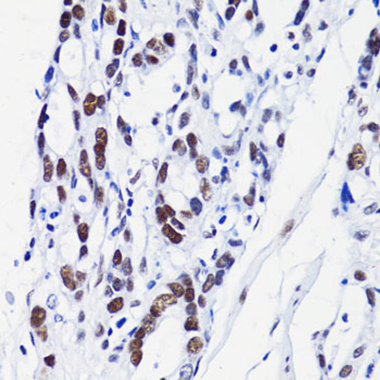 Immunohistochemistry of paraffin-embedded Human gastric cancer using Acetyl-Histone H2B-K15 Polyclonal Antibody at dilution of  1:100 (40x lens).