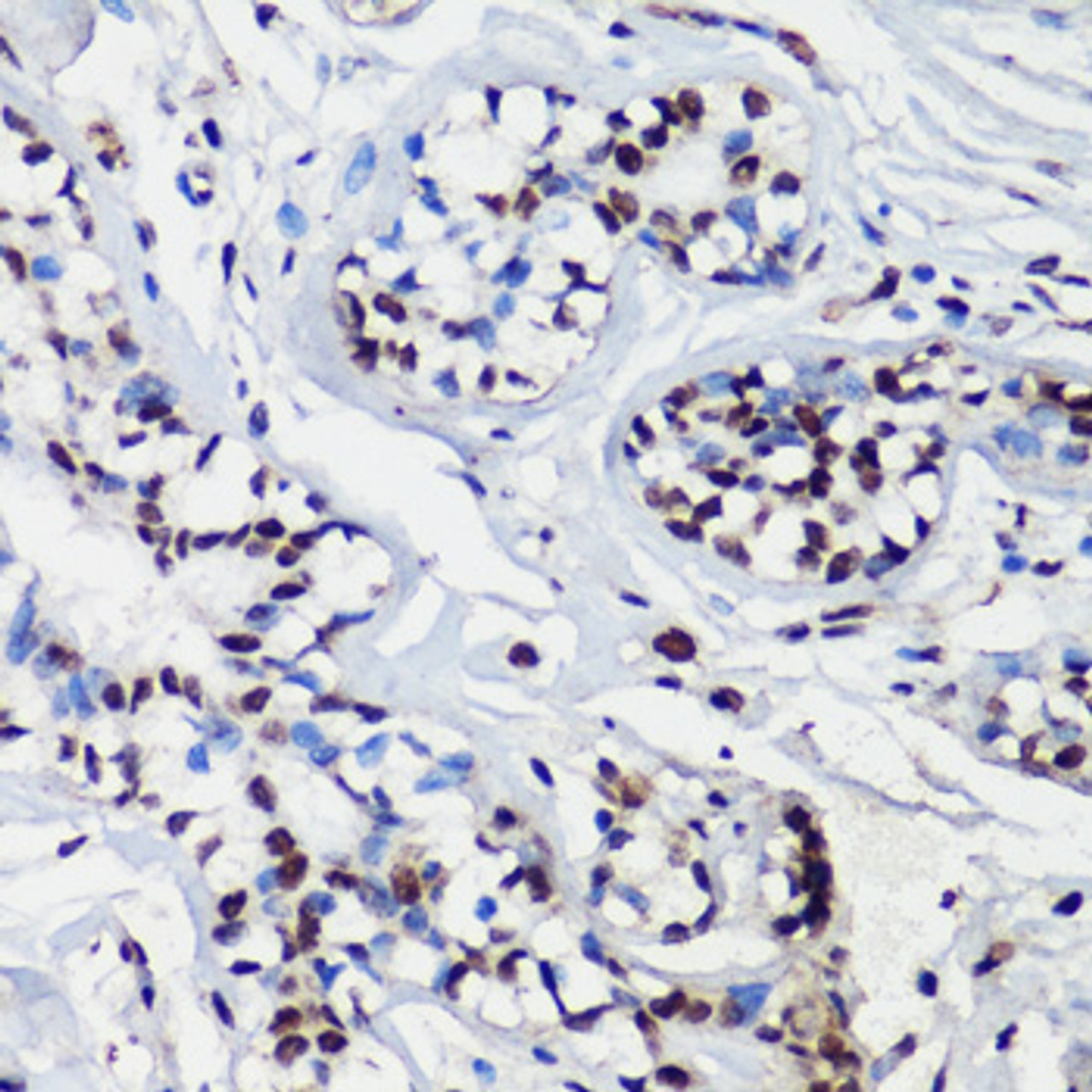 Immunohistochemistry of paraffin-embedded Human breast using p27 KIP 1 Polyclonal Antibody at dilution of  1:100 (40x lens).