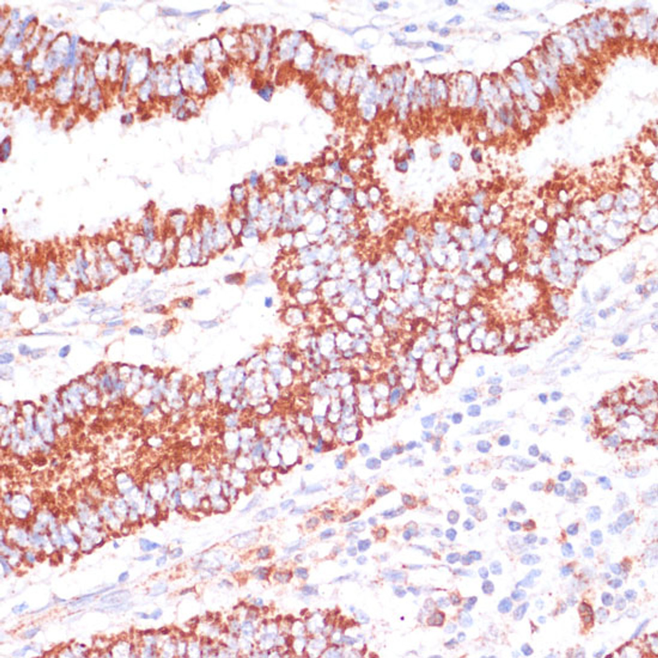 Immunohistochemistry of paraffin-embedded Human colon carcinoma using ENTPD6 Polyclonal Antibody at dilution of  1:100 (40x lens).
