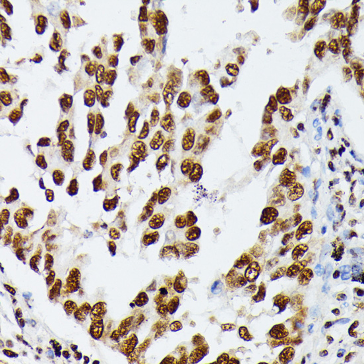Immunohistochemistry of paraffin-embedded Human lung cancer using HNRNPD Polyclonal Antibody at dilution of  1:100 (40x lens).